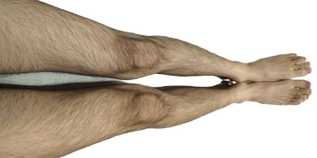 脱毛前のスネ毛の濃い写真（ビフォーアフター）