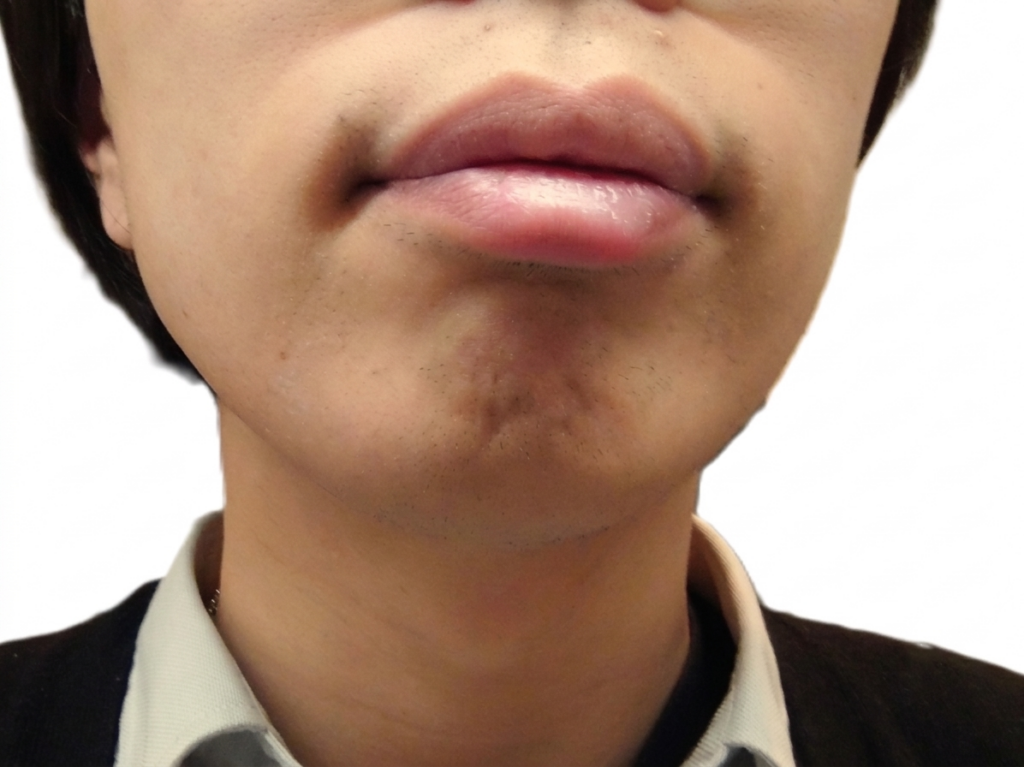 医療ひげ脱毛15回目の効果｜青ヒゲ解消経過写真　ビフォーアフター　（口周り）