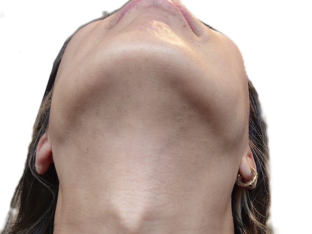 【比較写真】ヒゲ脱毛追加２回（気になるヒゲほぼなくなった状態）