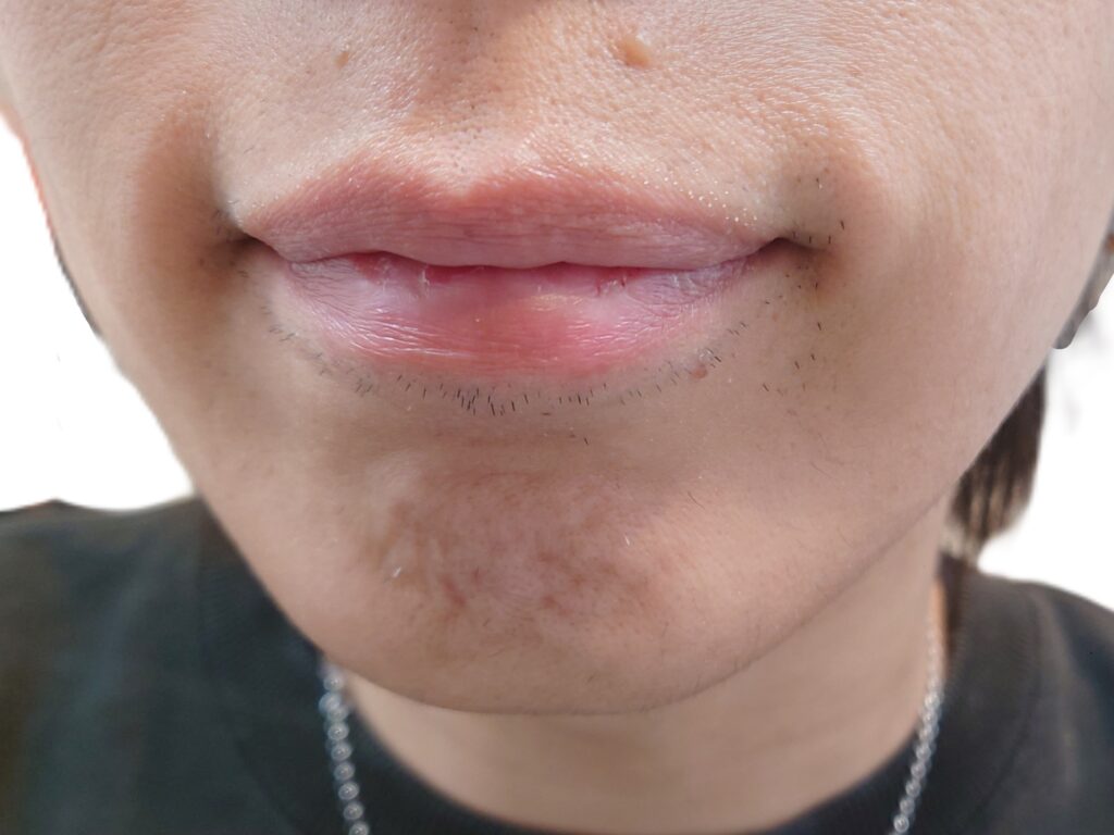 【比較写真】唇の下のヒゲが濃く残る状態