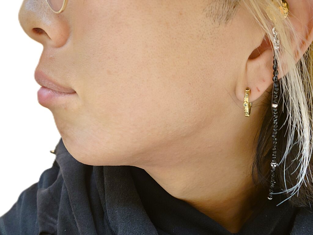 【比較写真】23回目のヒゲ脱毛終了直後の写真（フェイスラインに水膨れができた状態）