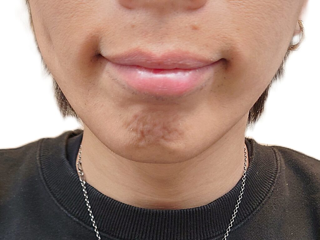 【比較写真】追加脱毛2回体験後