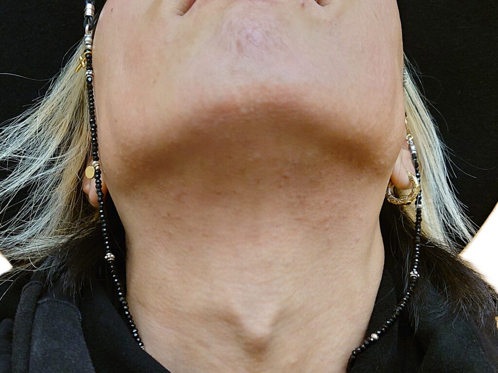 【比較写真】23回目のヒゲ脱毛終了直後の写真（アゴ下に水膨れができた状態）