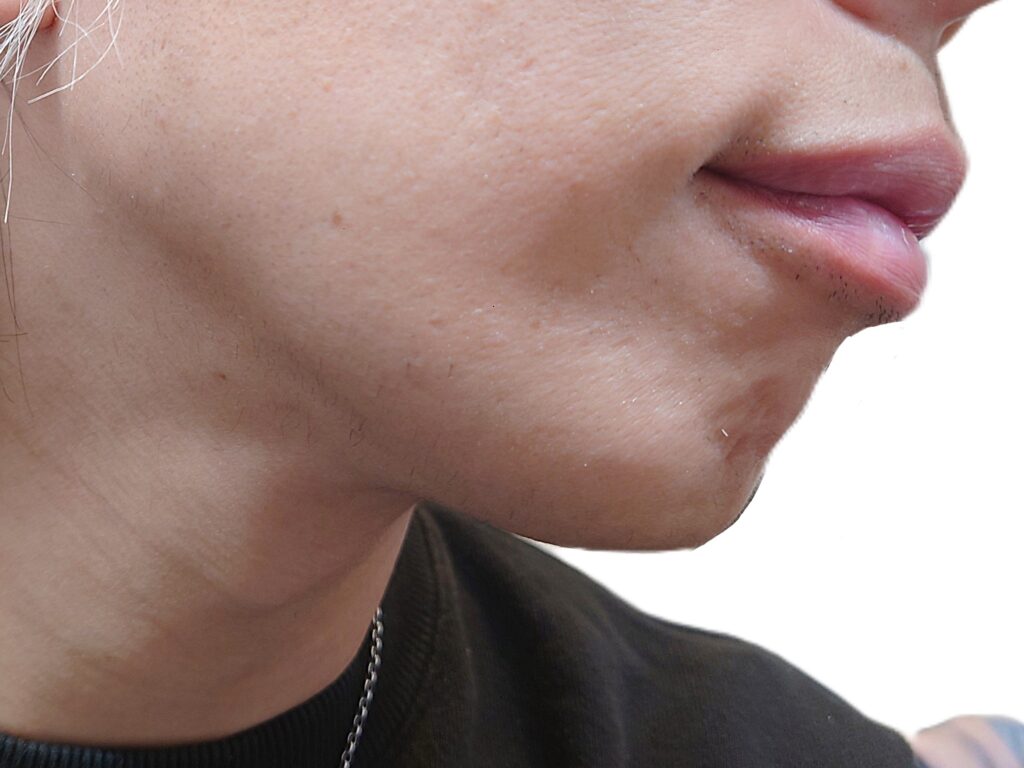 【比較写真】アゴ下に白髪ヒゲが生えている状態