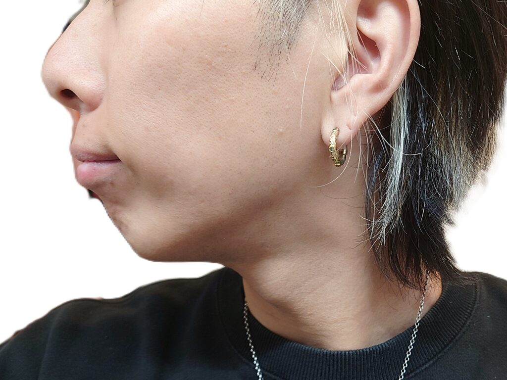 【比較写真】ヒゲ脱毛23回目前（口周りのヒゲが気なる状態）