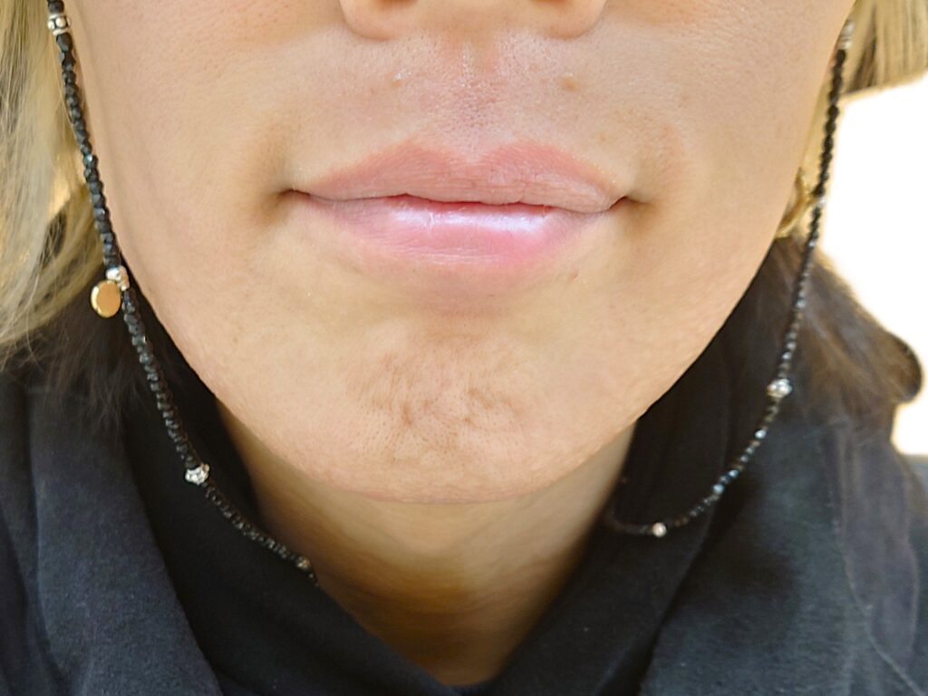 【比較写真】23回目のヒゲ脱毛終了直後の写真（赤みがができた状態）