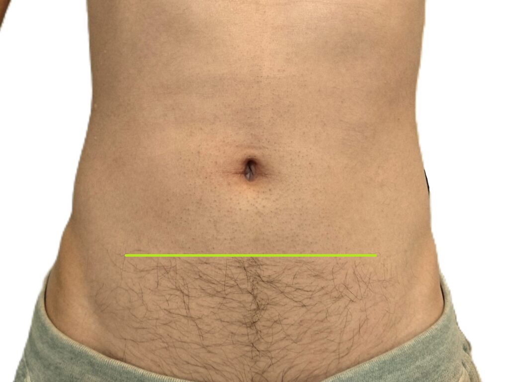 脱毛箇所に境目ができて不自然な仕上がりになった状態【写真】